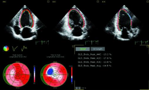 Heart muscle strain