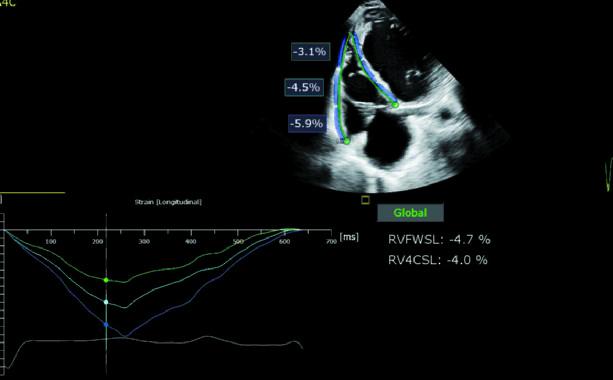 Right-heart strain analysis