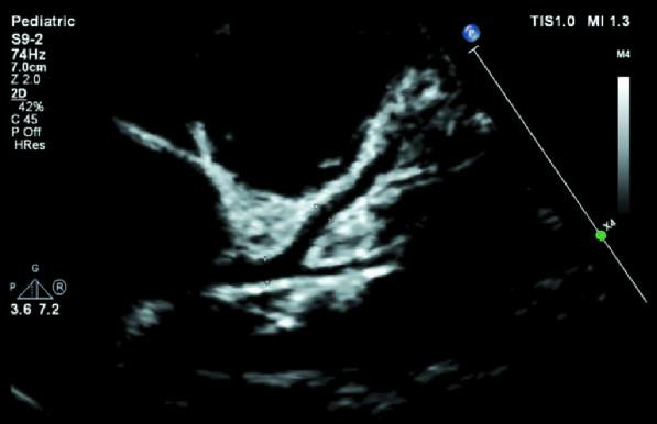 Pediatric cardiac detail
