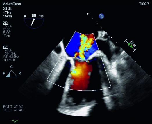 Cardiac color Doppler