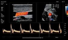 Vascular Doppler