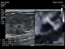 Breast elastography