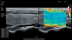 Thyroid stiffness assessment